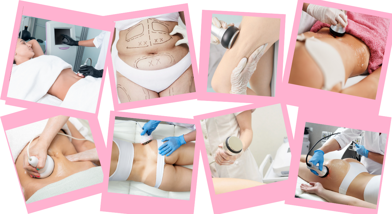 Ultrasound Cavitation